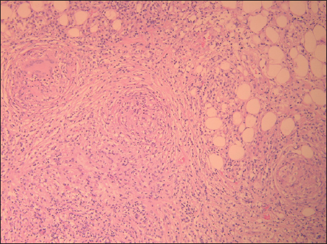 High-power view showing peritoneal fat with extensive, well-defined, necrotizing granulomas.